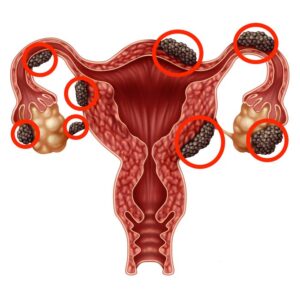 Psychological and psychopathological aspects related to endometriosis